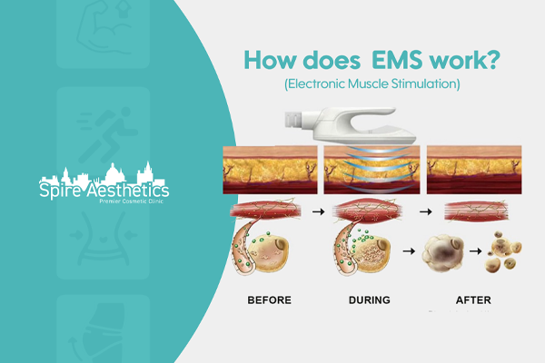 EMS treatment for post pregnancy weight loss treatment Stockport
