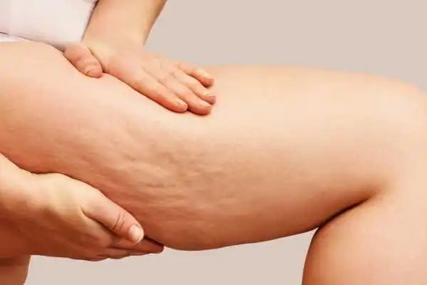 Image of woman showing leg with cellulite Stockport