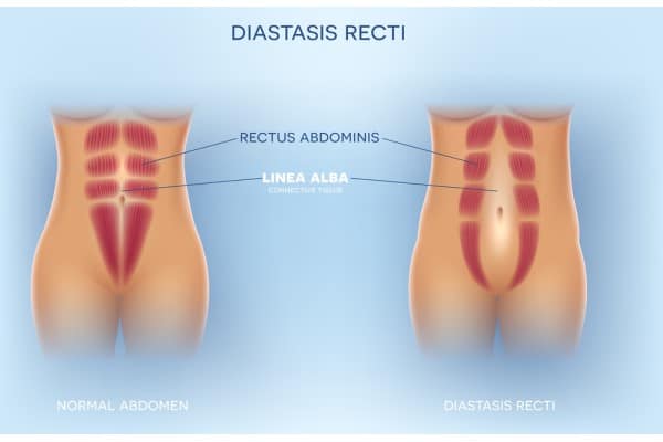 What Non-Surgical Options Are Available for Diastasis Recti Stockport?