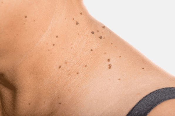 Are you looking for easy skin tag removal Stockport - then contact Spire today!