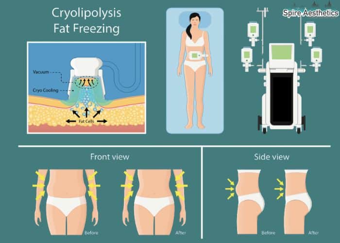 Image of diet and fat freezing combined for best results for Spire Aesthetics Stockport