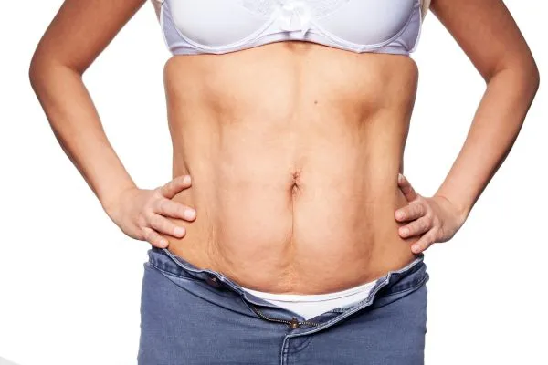 sagging skin on woman's stomach after weight loss injections Stockport