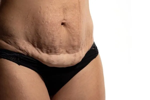 Image of womans stomach after weight loss injections Stockport showing saggy skin